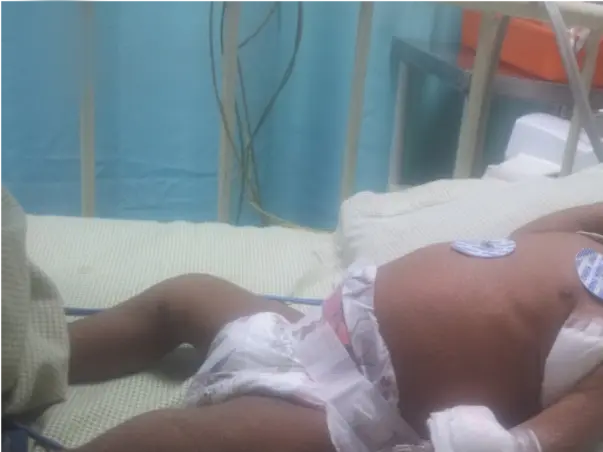 I am fundraising to save my 5 months old kid Venudev - Bone Marrow Transplantation treatment