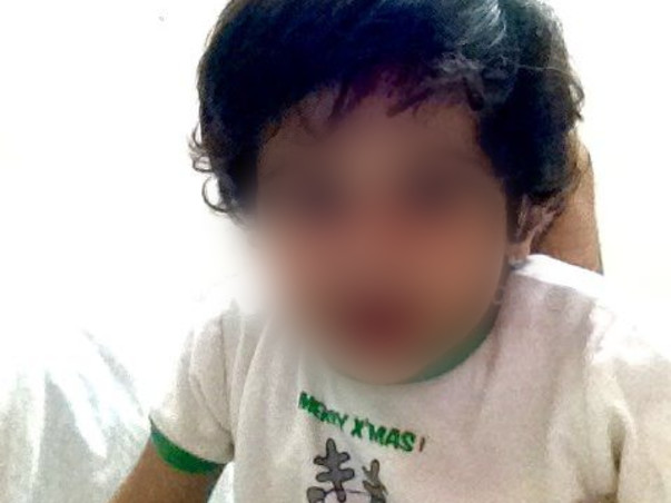 Aanya's second cochlear implant