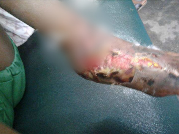 Help this 10-year-old girl so that she doesn't lose her leg !