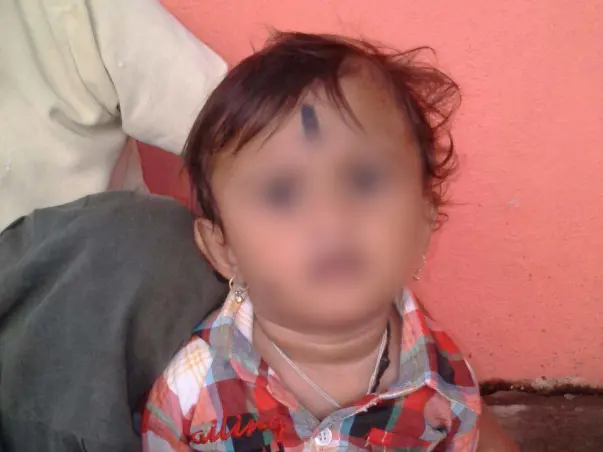 Help Baby Nuthan Undergo Cochlear Transplant