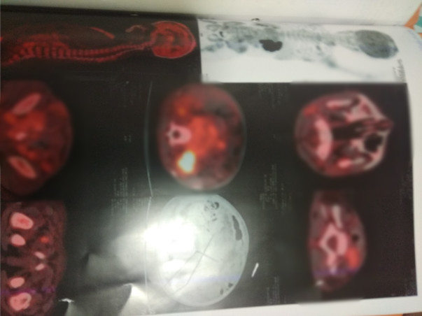 Help kavyadharshni recover from cancer