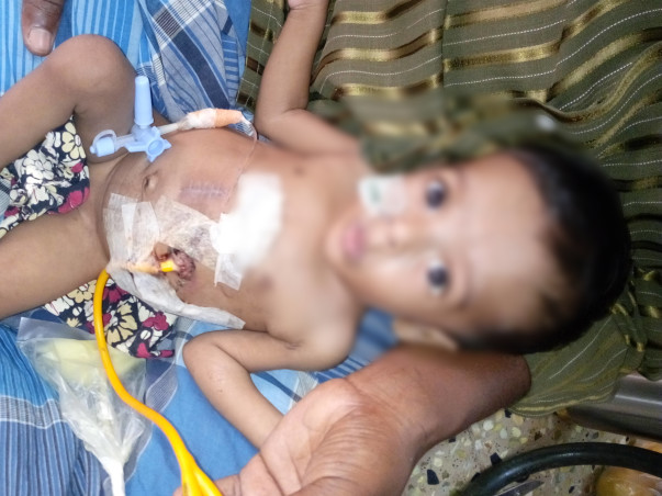 This Baby requires a surgery so that he can eat through his mouth