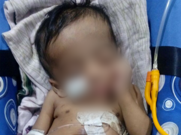 This Baby requires a surgery so that he can eat through his mouth