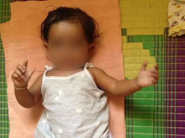 Fund Raising For Congenital Heart Surgery Of Child