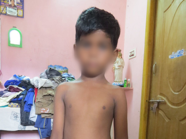 Help for 5 year old Divesh's Colostomy Closure Surgery