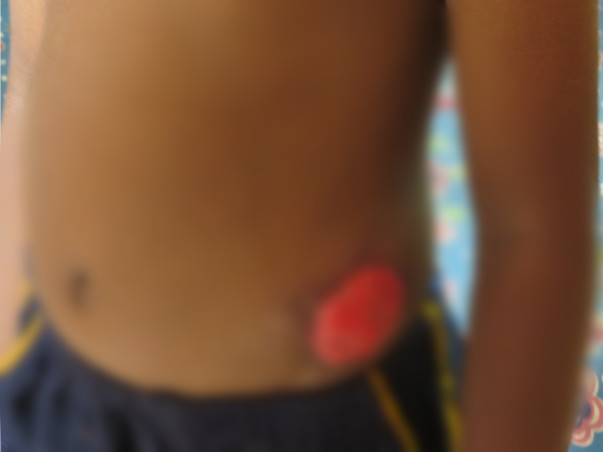 Help for 5 year old Divesh's Colostomy Closure Surgery