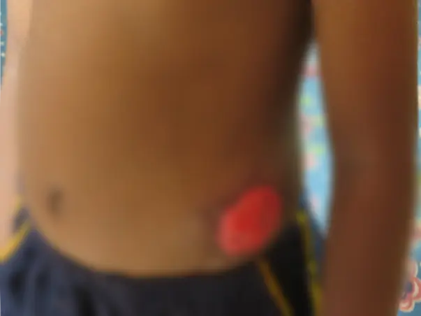 Help for 5 year old Divesh's Colostomy Closure Surgery