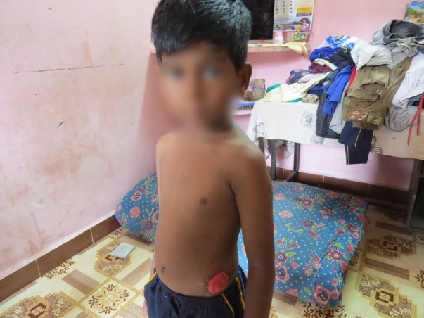 Help for 5 year old Divesh's Colostomy Closure Surgery