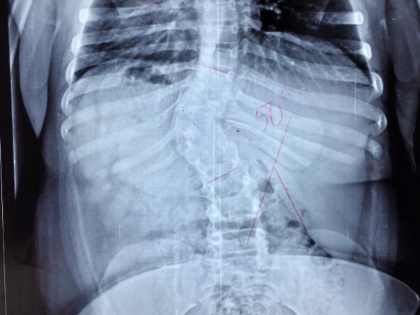 Your Help Can Save 10-Year-Old Shivani From Getting Paralysed