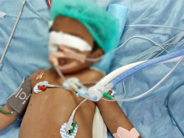 3-year-old Who Drank Paint Thinner Is Suffering From Organ Failure
