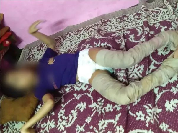 Help Ashifa To Overcome Her Physical Challenges