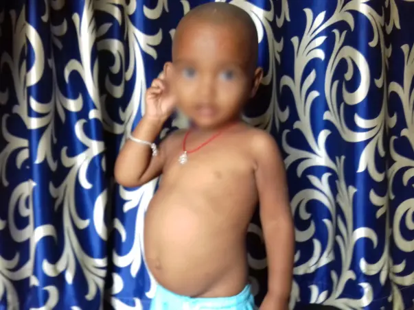 Help 2-year-old Akhilesh undergo a liver transplant