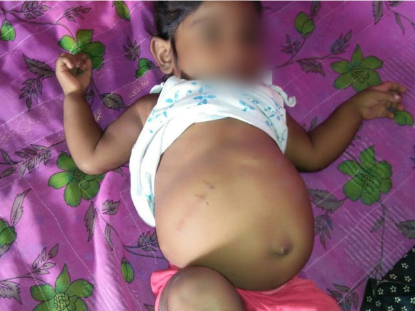 1-year-old Keerthana with a bloated stomach fights liver failure