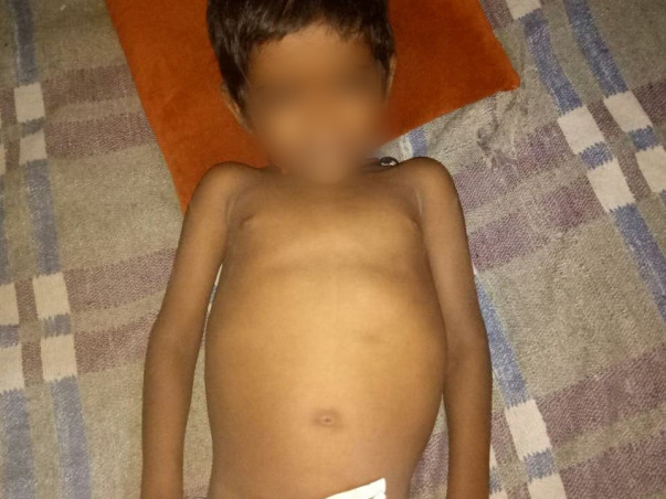 4-year-old Manish urgently needs a liver transplant to survive