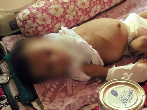 Help 6-Month Samriddho Fight A Severe Liver Disease & Bloated Stomach