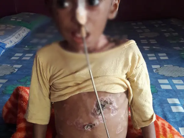 Help This 2-year-old Who Has A Disease That Is Eating Up Her Skin