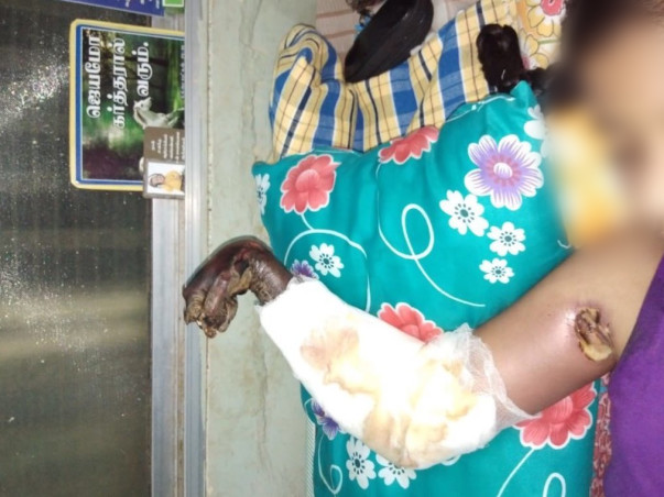 Help Helen (Her hands got amputated in a Electric shock)