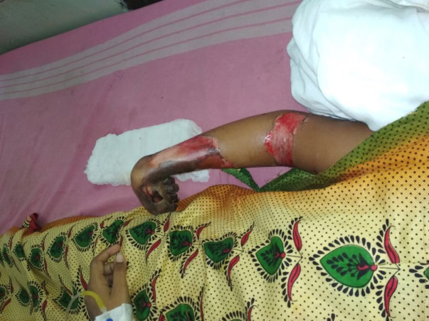 Help Helen (Her hands got amputated in a Electric shock)