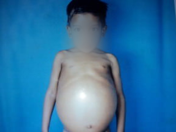 Help Joseph Raj From Gaucher Disease