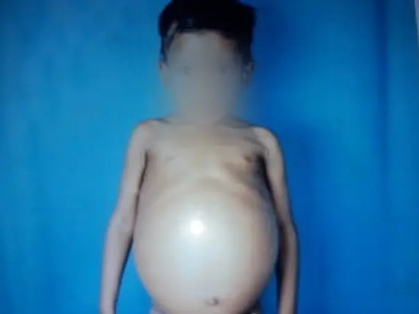 Help Joseph Raj From Gaucher Disease