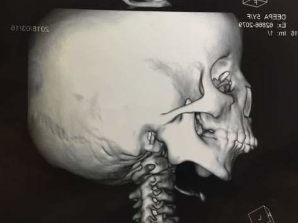 Help Deepa Who Requires A Jaw Surgery To Open Her Mouth