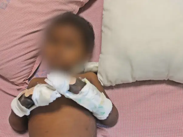 Gokul Has A Flesh-Eating Infection That Has Put His Life In Danger