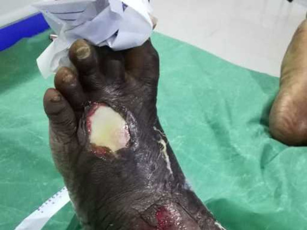 Help My Brother Undergo Liver Transplant after curing the leg infectio