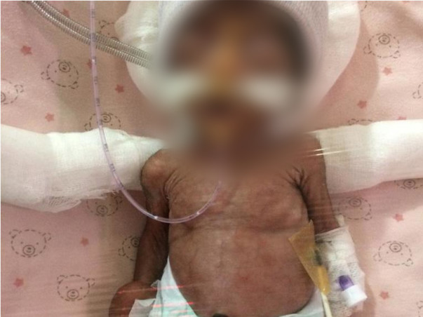 HELP B/O Anasuya , a Baby girl in NICU recover