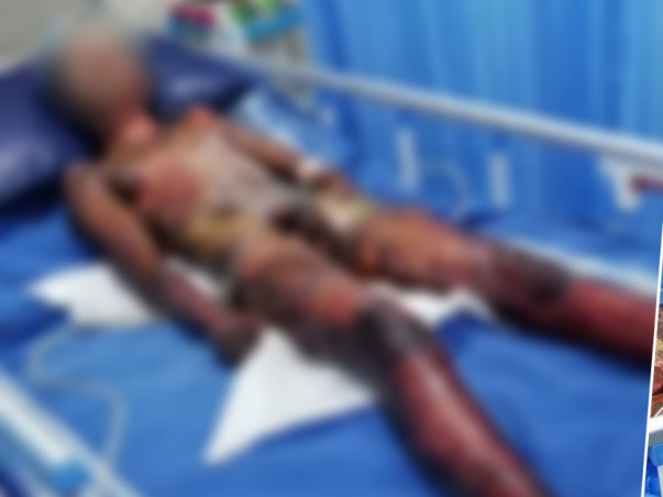 Help Shaik Recover From Serious Burns