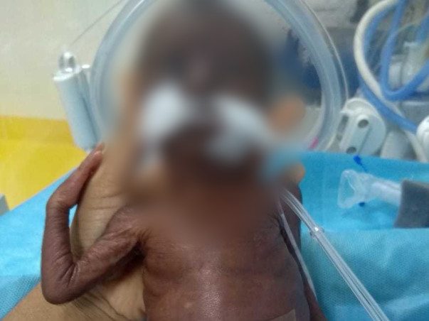 Help Premature Baby To Live