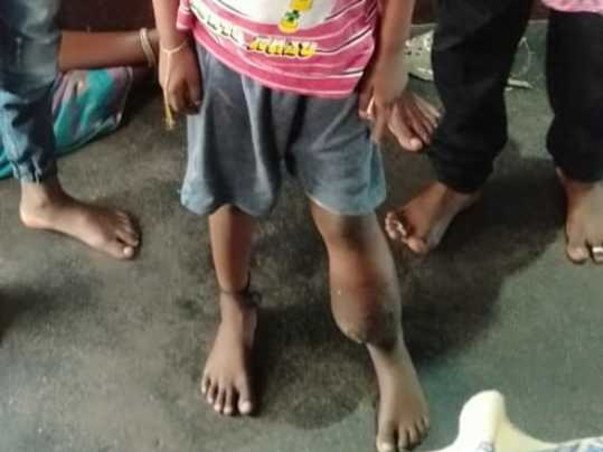 Help dhanush suffering from Bone Cancer