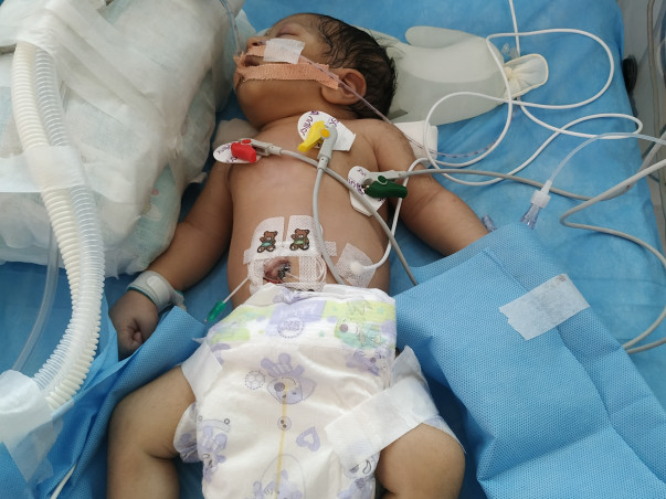 New Born Baby With Lungs And Pulmonary Hyperstress