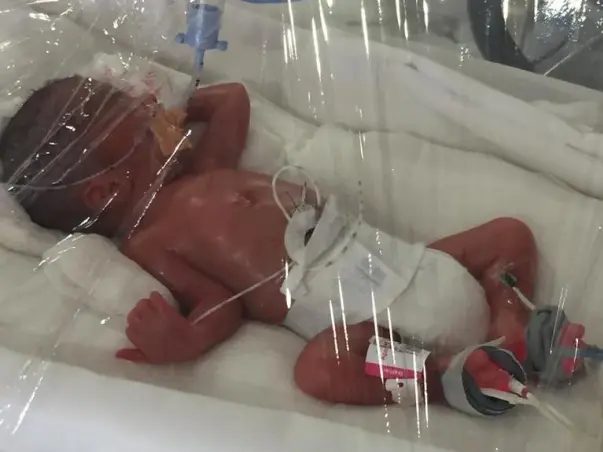 Help Premature Baby Born At 27week 750gms Operated For Gut Perforation