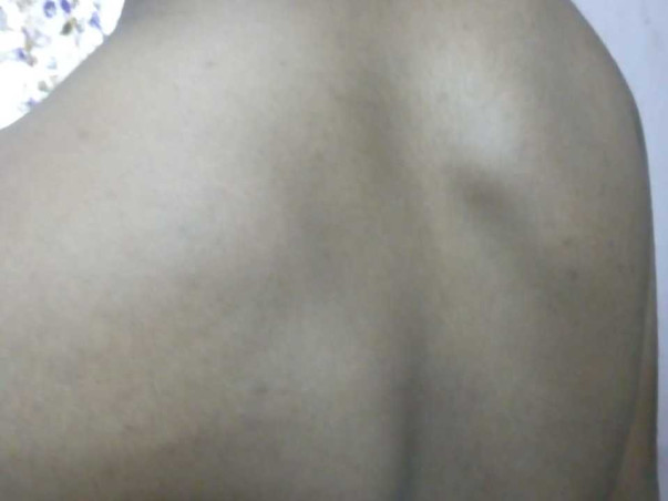 Detethering and dorsal scoliotic deformity correction