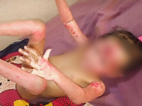 Help 7 Years Old Subhasmita Sahoo Fight Burn Due To GAS Cylinder Blast