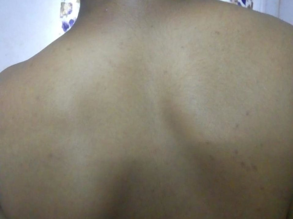 Detethering and dorsal scoliotic deformity correction