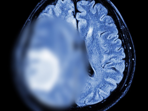 Help Tinotenda Fight Brain Tumor