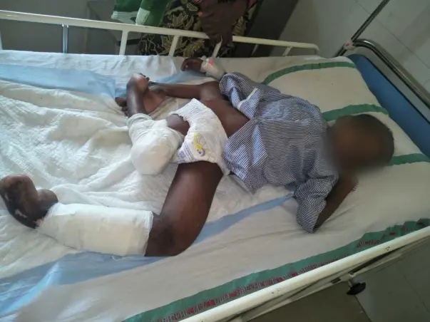 Help 11 Years Old Indian Boy Born With An Extra Leg Undergo Surgery