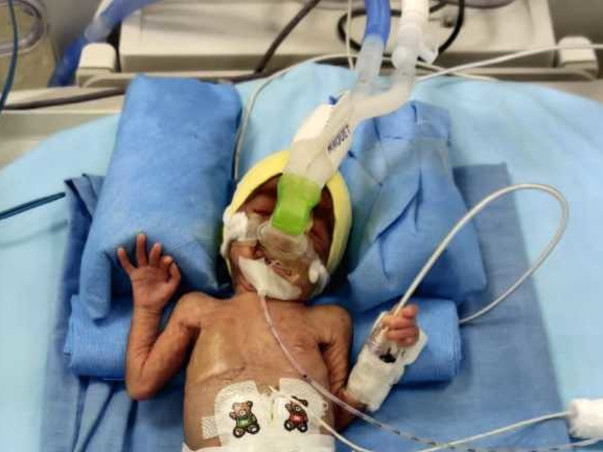 Help My preterm baby to recover