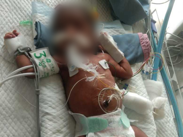 3 Days Old Baby Of Nandini  Needs Your Help Fight Valvular Stenosis