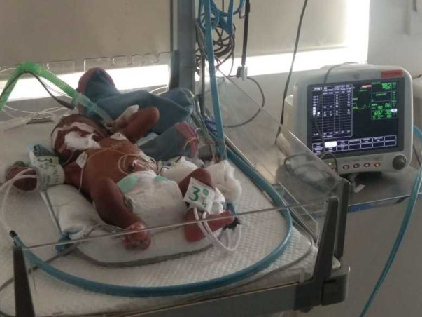 3 Days Old Baby Of Nandini  Needs Your Help Fight Valvular Stenosis