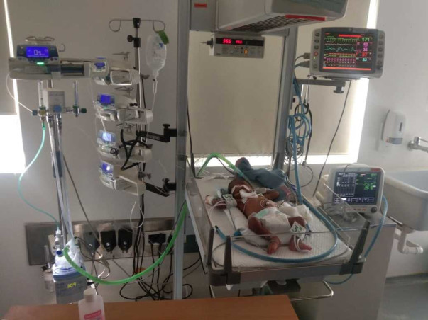 3 Days Old Baby Of Nandini  Needs Your Help Fight Valvular Stenosis