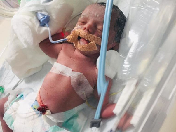 16 Days Old Baby Samuel Isaac Needs Your Help Fight Diaphragmatic Hernia