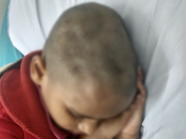 8 Years Old Haana Needs Your Help Fight Bone Damage On Forehead