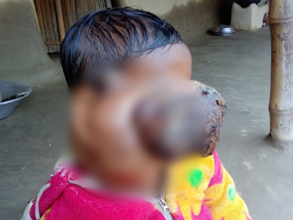 Help Ashik Recover From Retinoblastoma