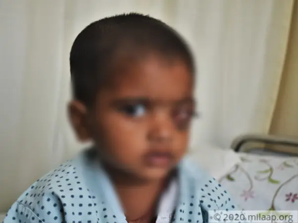 Support Tanveer Kusar  Recover From Retinoblastoma