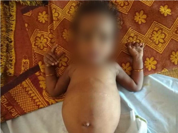 Help my daughter for liver transplant