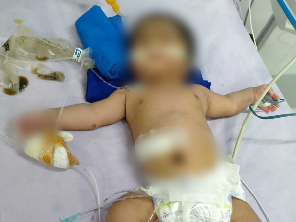 12 days old Baby of Kalyani needs your help fight Hirschsprung disease