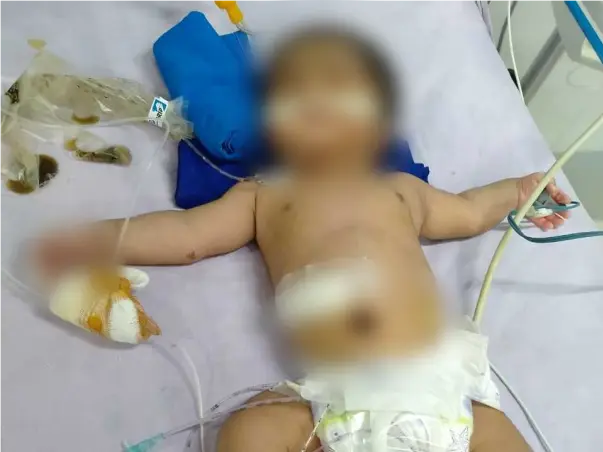 12 days old Baby of Kalyani needs your help fight Hirschsprung disease