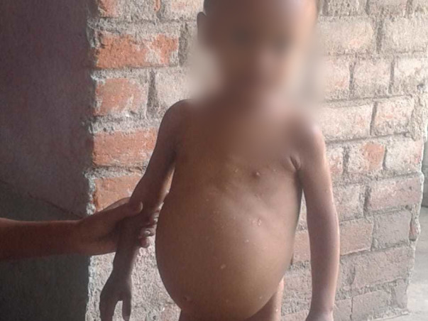 Support Anugrah Paul Recover From Hirschsprung's Disease